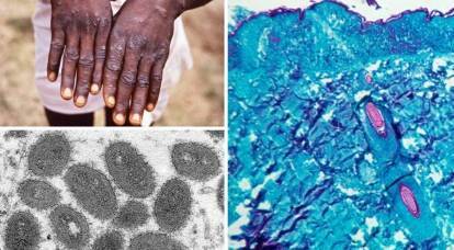 Telung negara AS nglaporake kenaikan kasus monkeypox