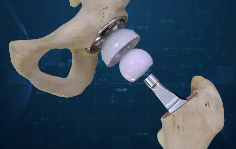 Rus bilim adamları ekstra güçlü implantlar geliştirdiler