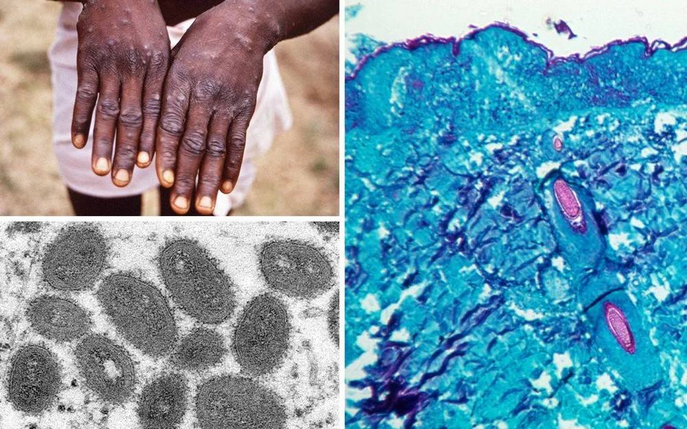 Trois États américains signalent une forte augmentation des cas de monkeypox